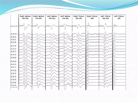 Multimodality IONM in spine surgery | PPTX
