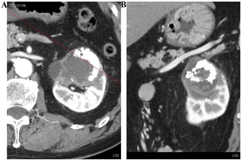 Invasive Urothelial Carcinoma Within A Calyceal Diverticulum Associated