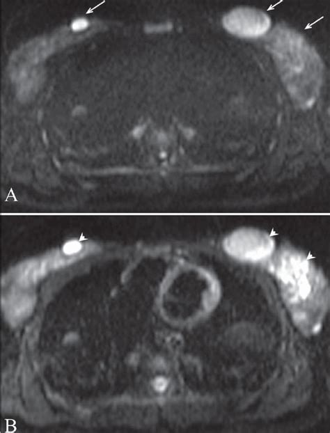 Fibroadenoma Diffusion Weighted Image A At A B Value Of 1000 Shows