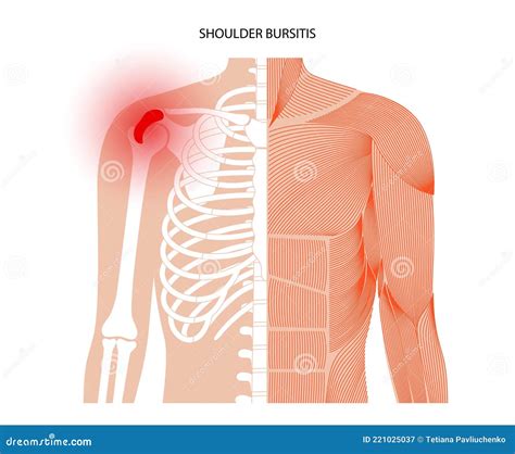 Concepto De Inflamación De Bursitis Ilustración del Vector