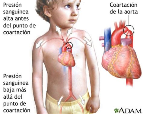 Cardiopatías Congénitas Y Los Síntomas De Un Soplo Cardiáco En Niños