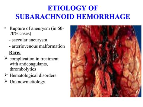 Hemorrhagic Stroke Ppt