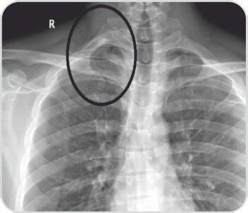 Arterial Thoracic Outlet Syndrome