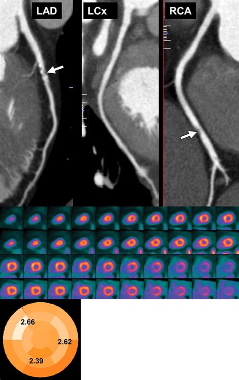 Cardiac Petct For The Evaluation Of Known Or Suspected Coronary Artery