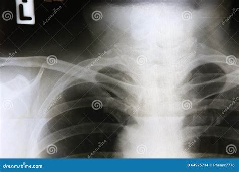 Film x-ray right clavicle stock photo. Image of abdomen - 64975734