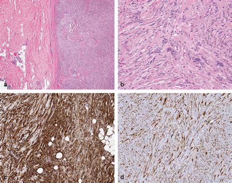 Superficial Cd Positive Fibroblastic Tumor A Low Power Shows A