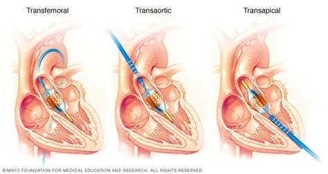 Transcatheter Aortic Valve Replacement Tavr 2022