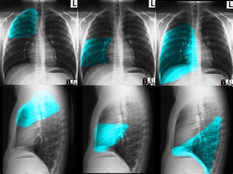 Chest X Ray Lung Parts And Fissures CXR Lungs