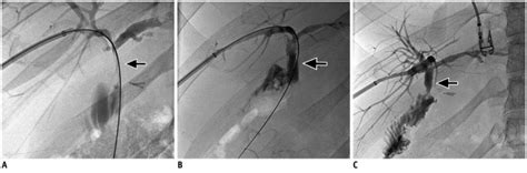 Stent Graft In Postsurgical Benign Biliary Stricture A Year Old