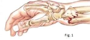 Fractura De Mu Eca Causas Y Tratamiento Camde