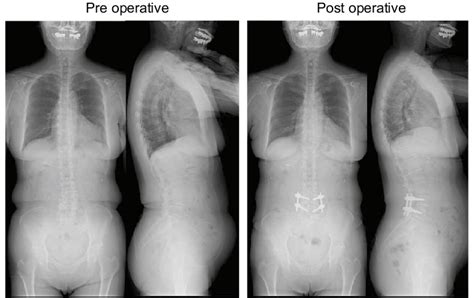 Standing Anteroposterior And Lateral Radiographic Images Before And