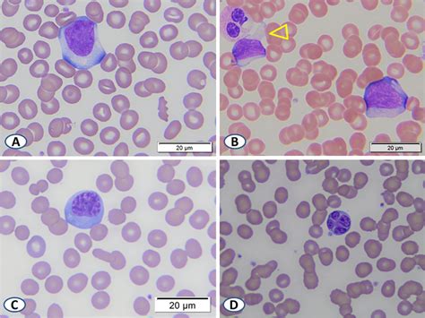 Representative images of typical reactive lymphocytes in the peripheral... | Download Scientific ...