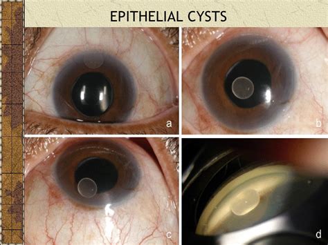 CATARACT SURGERY COMPLICATIONS