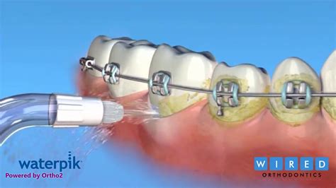 How To Use A Waterpik With Braces Youtube