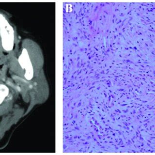 Imaging And Pathological Findings Of The Solitary Fibrous Tumor In Case