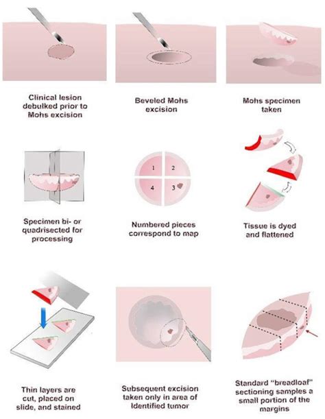 Mohs Micrographic Surgery Skin Cancer Advantages Complications