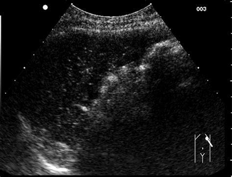 Sonography Of The Spleen Benter 2011 Journal Of Ultrasound In