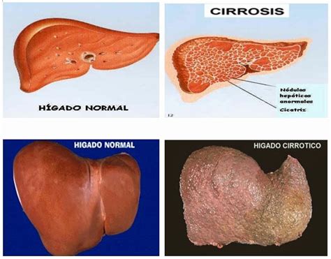 Definici N De Cirrosis Hep Tica Cirrosis Hep Tica