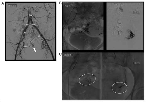 Clinical Conundrum A 39 Year Old With Chronic Retained Products Of