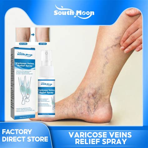 South Moon Varicose Vein Spray Cure Redness Vasculitis Circulation