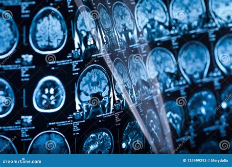 The X-ray of the Human Brain Stock Image - Image of health, radiology: 124999293