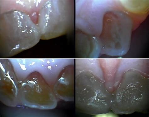 Dentinogênese imperfeita associada à osteogênese imperfeita Docfy