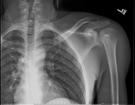 Doc Cottle's Desk: Posterior shoulder dislocation confirmed by ultrasound