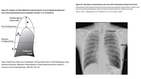 Pneumothorax Diagram