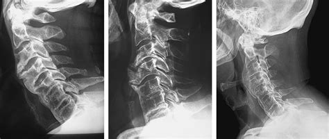 Long Term Results Of Surgical Treatment Of Dysphagia Secondary To Cervical Diffuse Idiopathic