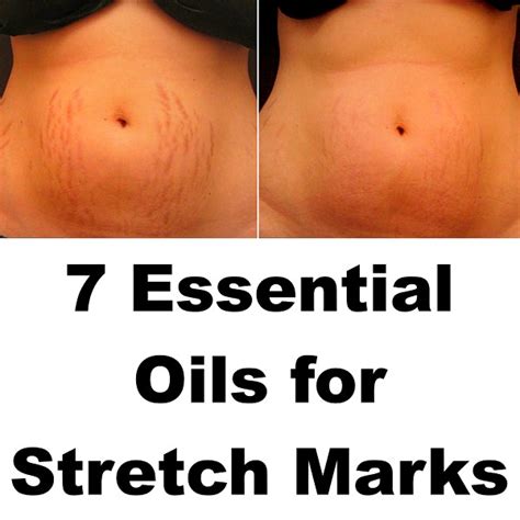 7 Essential Oils To Get Rid Of Stretch Marks Fast