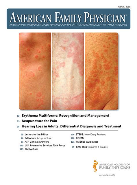 Erythema Multiforme Recognition And Management Aafp