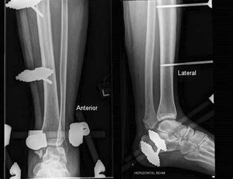 Rare Bosworth Fracture Dislocation Variant Of An Irreducible Distal