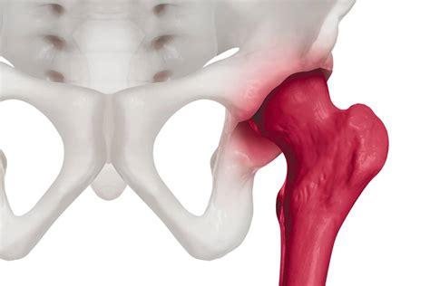 Artritis Y Artrosis Qu Son Causas Y Consecuencias Sports Medicine