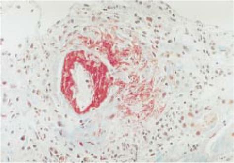 Fibrinoid Necrosis Of A Small Intrarenal Artery With Peri Download High Resolution Scientific