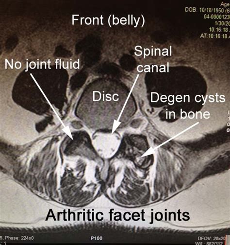 Facet Arthritis - Drwolgin