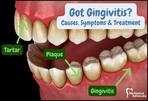 Pregnancy Gingivitis: Causes, Symptoms & Treatment 2024