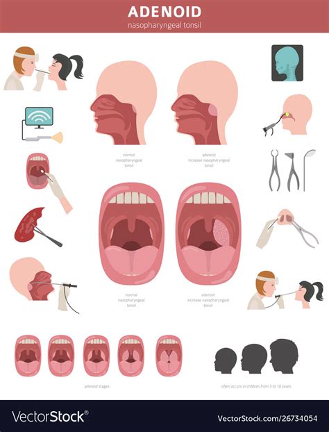 Nasal And Throat Nasopharynx Diseases Adenoids Vector Image