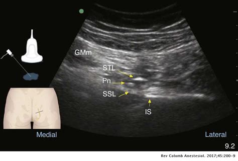 Gluteal Nerve Block