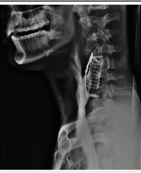 Figure 2 From Primary Repair Of Esophageal Perforation Following