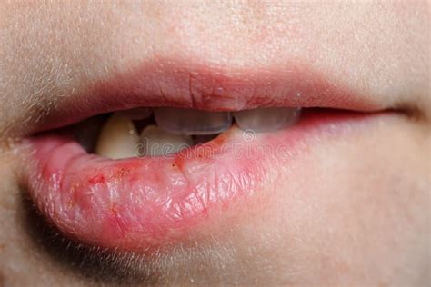 Macro Lips with Severely Dry Bleeding Cracked or Chapped Lips. Stock Photo - Image of brittle ...