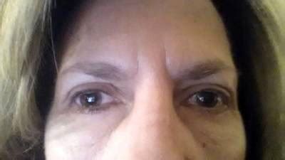 Blepharoplasty price » Eyelid Surgery: Cost, Photos, Rewiews, Q&A