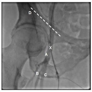 Relevant regional anatomy for femoral artery catheterization: A: Common ...