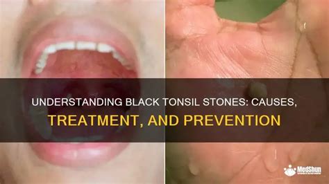 Understanding Black Tonsil Stones: Causes, Treatment, And Prevention ...