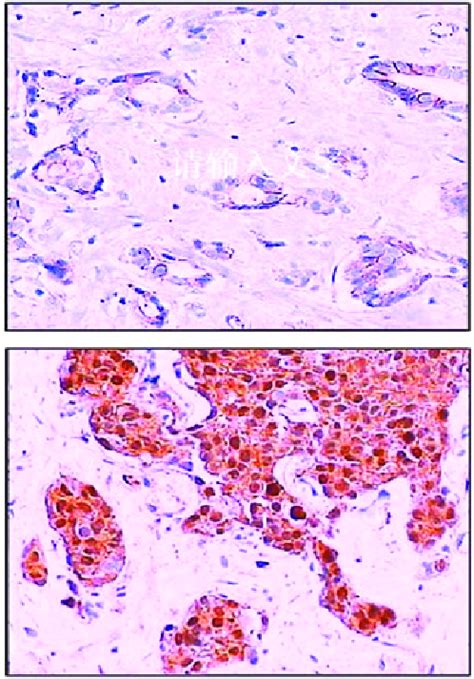 β Catenin Immunohistochemical Analysis In Breast Invasive Ductal Cancer Download Scientific