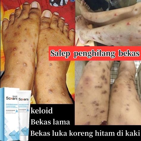 Salep Bekas Luka Bekas Luka Koreng Hitam Di Kaki Bekas Koreng Lama