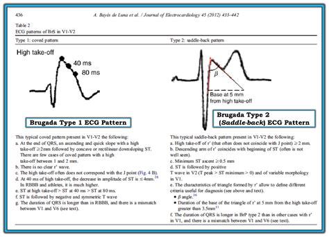 Dr Smiths Ecg Blog Hyperthermia And St Elevation