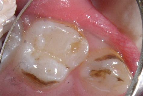 Black Stains On Teeth Near Gums Teethwalls 9DA