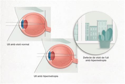 Què és la Hipermetropia Hospital Clínic Barcelona
