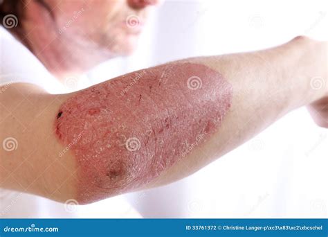 Person With Plaque Psoriasis Of The Arm Stock Photography Image 33761372