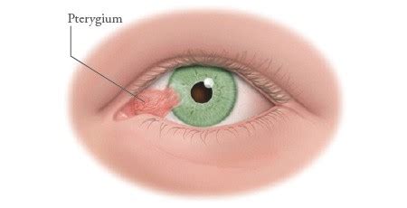 Understanding Pterygium Growth | New Vision Eye Center